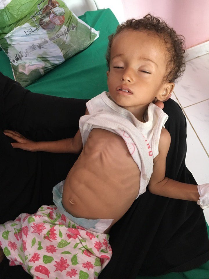 Aden, Yemen - “If you remember nothing of #Yemen remember Hussein Mazen Hussein - malnourished and fighting for every breath.” Courtesy: BBC, Orla Guerin. 