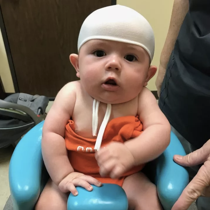 Jonas has to wear a head-shaping helmet 23 hours a day for three to six months. 