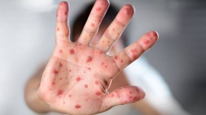 <p>Small Drop in Vaccination Could Triple Number of Measles Cases in United States</p>