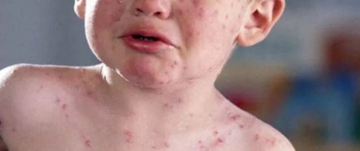<p>Measles is an extremely contagious and potentially fatal disease that can spread very easily, particularly to those who are not immune </p>