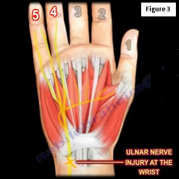 Ulnar Claw Hand | HuffPost