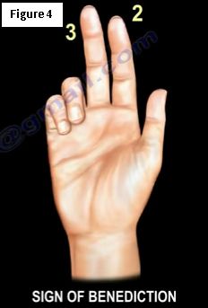 claw finger deformity