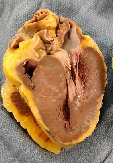 <p>My heart, HCM. The white areas are scar, the thickness is 2.5 times normal. </p>