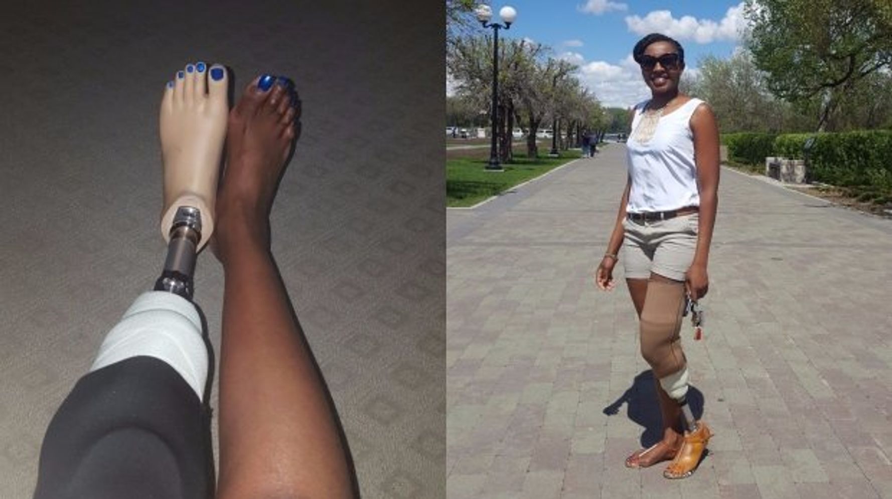 Woman plans to help fellow Rwandan amputees get prosthetics