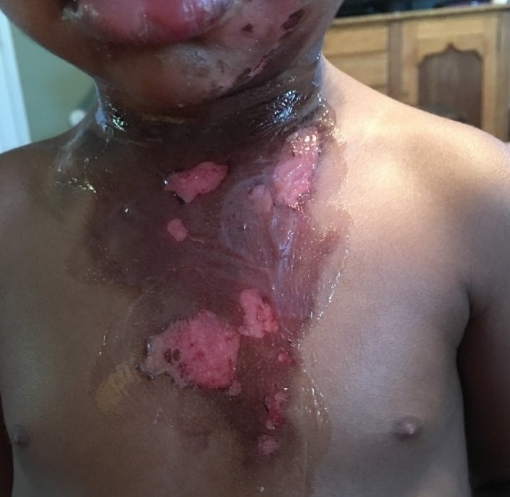 Burns Tracy Marie Garth's son allegedly suffered while at the police station.