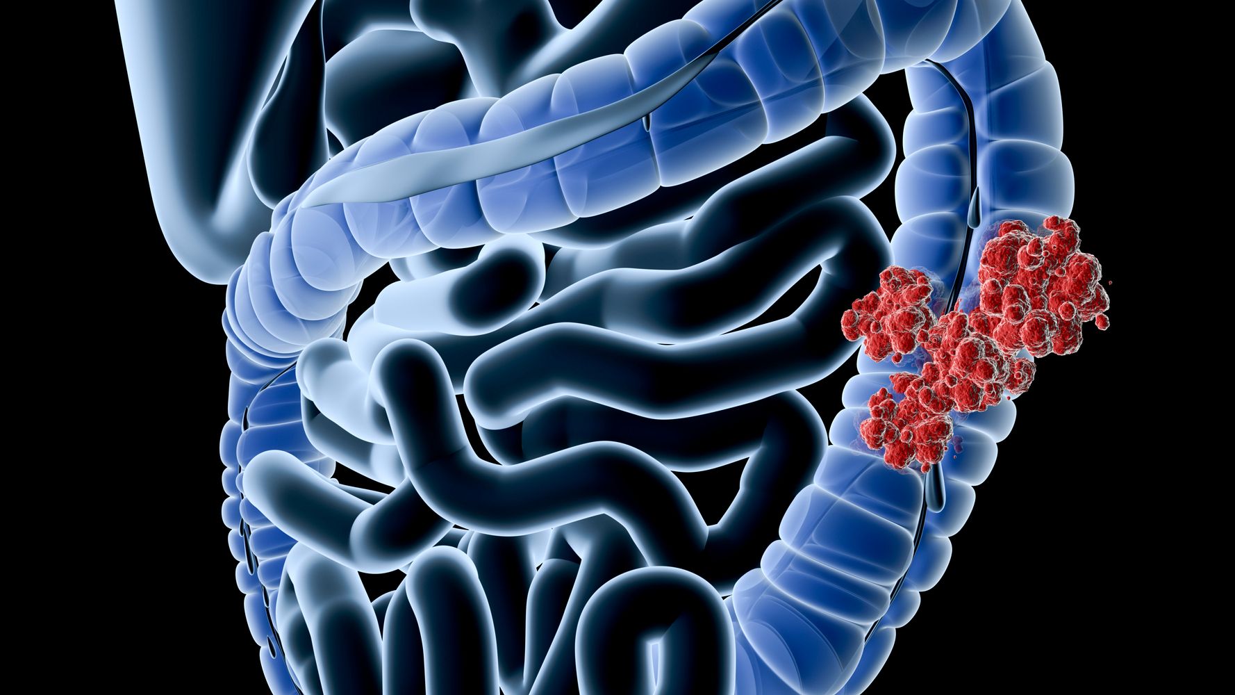 colorectal-cancer-death-rates-rise-for-young-white-adults-huffpost-life