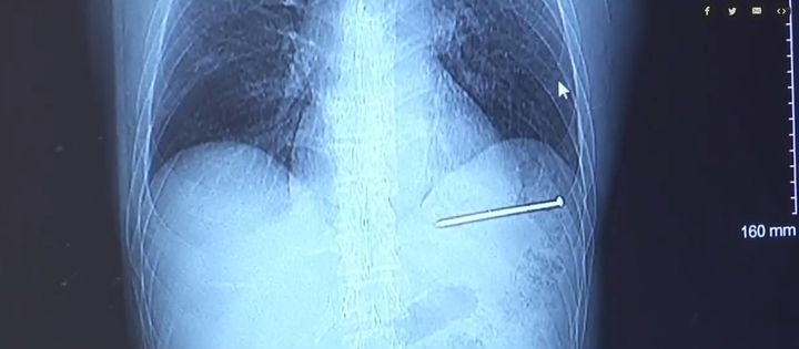 An x-ray showing the nail in Doug Bergesons chest.