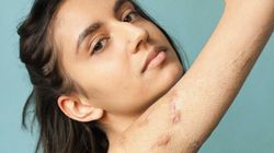 'Behind The Scars' Photo Series Shows All Skin Is Beautiful