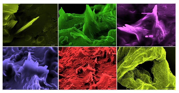 The protruding elements seen in the different slides are cholesterol crystals. Those elements are arising from within the artery wall, causing tearing and damage to the artery. The colors have been added for enhancement and imagery.