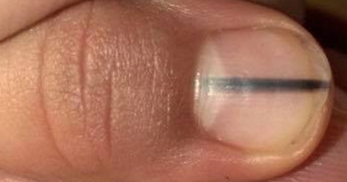 Dark Stripe On Nail The Unexpected Symptom Of Skin Cancer We Should