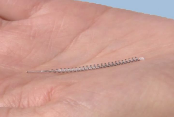 An Essure implant. 