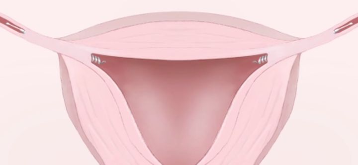 Scar tissue develops around each coil, blocking the fallopian tubes so sperm cannot pass.