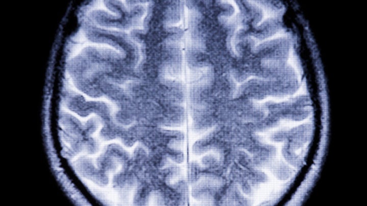 A new disability benefit regime has cut the amount of money given to those living with Multiple Sclerosis, figures reveal