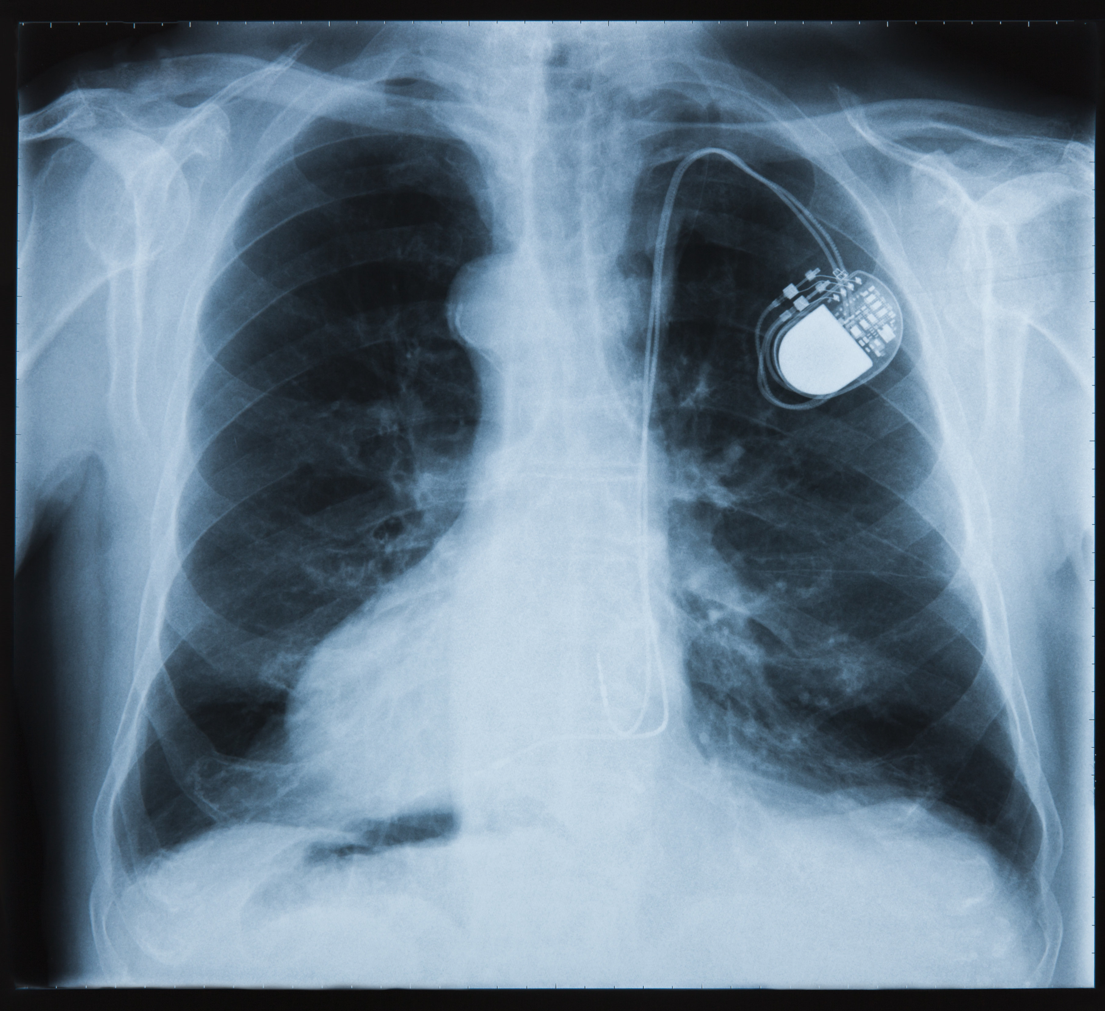 Over 700,000 Pacemakers Discovered To Have A Cyber-Flaw | HuffPost UK Tech