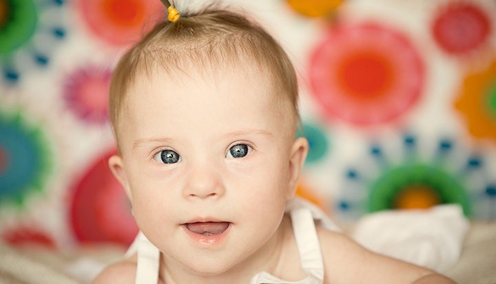 The sparkling stars that people with Down syndrome often have in their eyes are called ‘Brushfield spots’ 