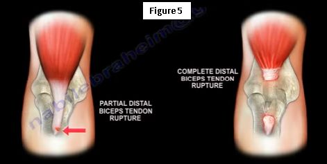 Supination Pronation Test  Distal Biceps Tendon Rupture 