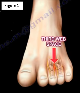 Big Toe Pain - Everything You Need To Know - Dr. Nabil Ebraheim 