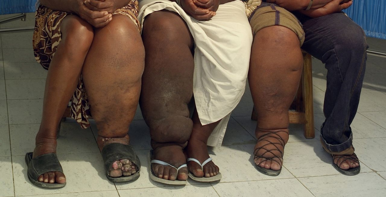 Three female patients in Haiti display their swollen legs, a symptom of elephantiasis.
