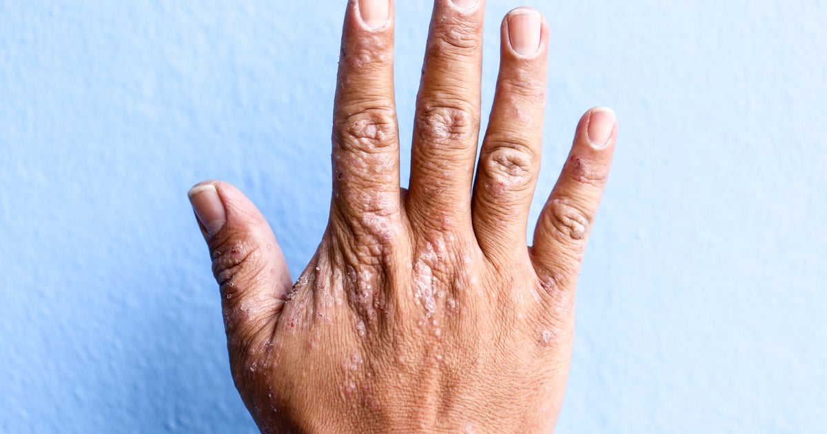 التهاب الجلد التأتبي