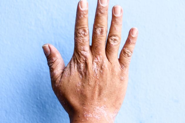 What Is Eczema Treatment Causes And Symptoms Of The Itchy Skin