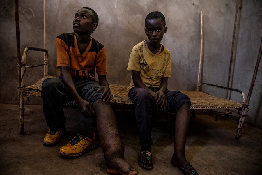 Two elephantiasis patients wait to meet with a traveling medical team in Uma.