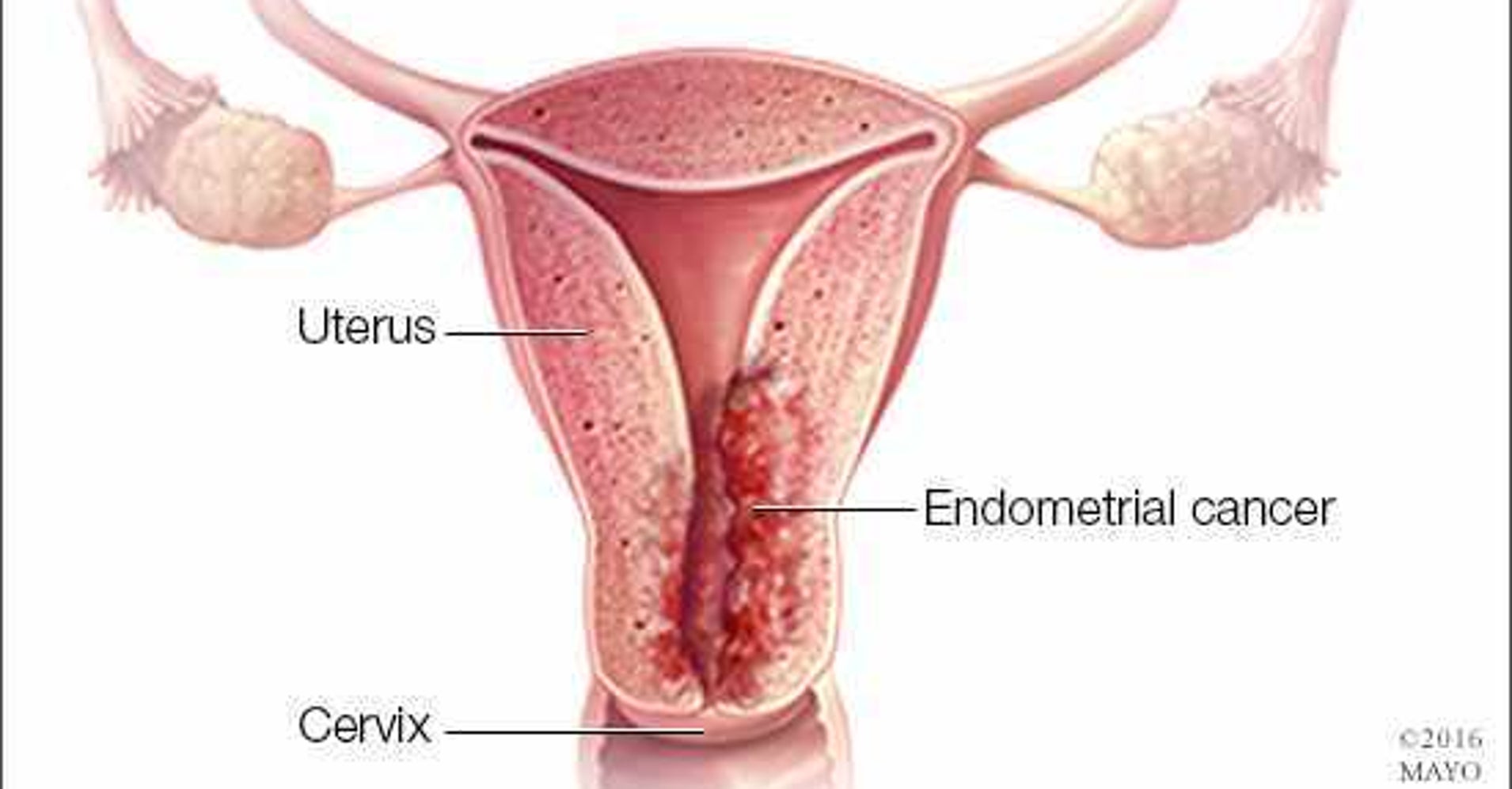 Endometrial Cancer: Risk Factors, Screening, Treatment ...