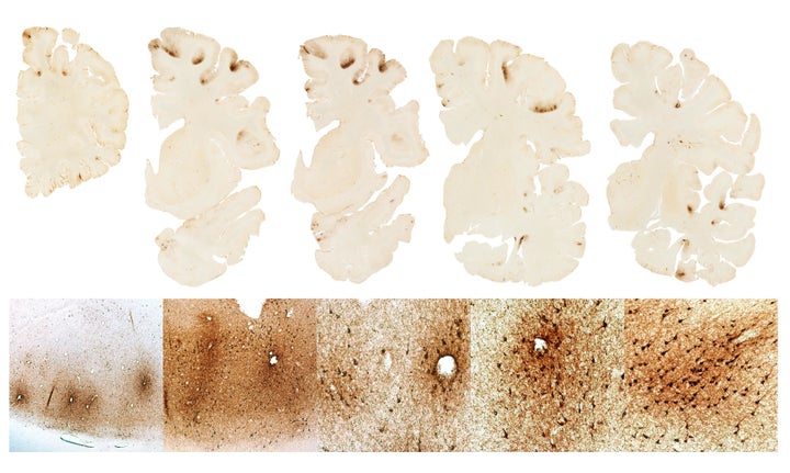 The top row shows severe deposition of tau protein in the frontal lobes of Hernandezs brain The bottom shows microscopic depo