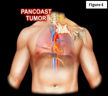 pancoast tumor neck