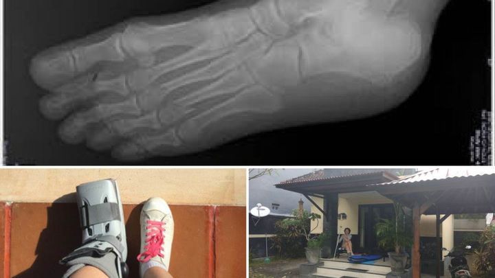 A blurry Balinese Xray, the Aircast that would become my only footwear for five months, and me outside our tiny villa in Nusa Dua.