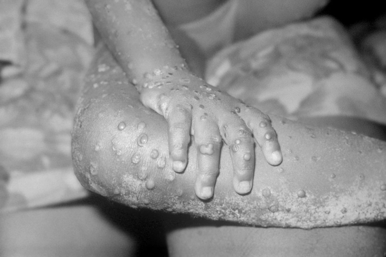 The legs and arms of a 4-year-old girl infected with monkeypox in Liberia. 