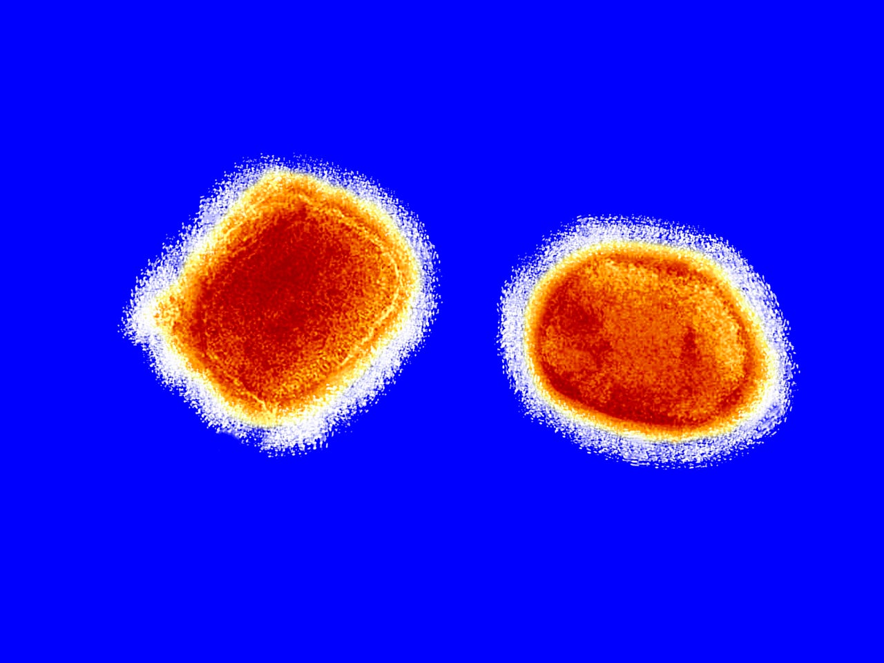 In humans, the signs and symptoms of the monkeypox virus (pictured) are similar to those of smallpox, though usually milder.