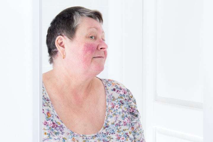 A woman with rosacea, a skin condition characterized by facial redness, small and superficial dilated blood vessels, pimples and sometimes ruddy skin.