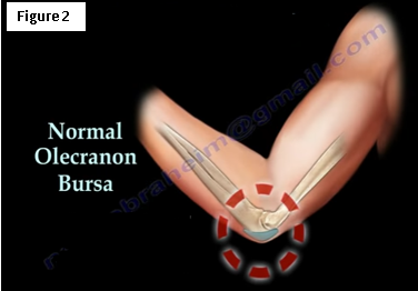 Effective Elbow Braces for Bursitis (Popeye's Elbow) Relief