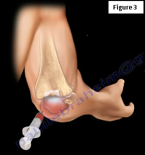 Effective Elbow Braces for Bursitis (Popeye's Elbow) Relief