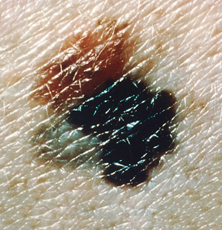 <p>Melanoma with asymmetry, irregular border, and multiple colors</p>