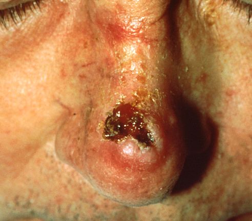 <p>Squamous cell carcinoma with ulcerated center</p>