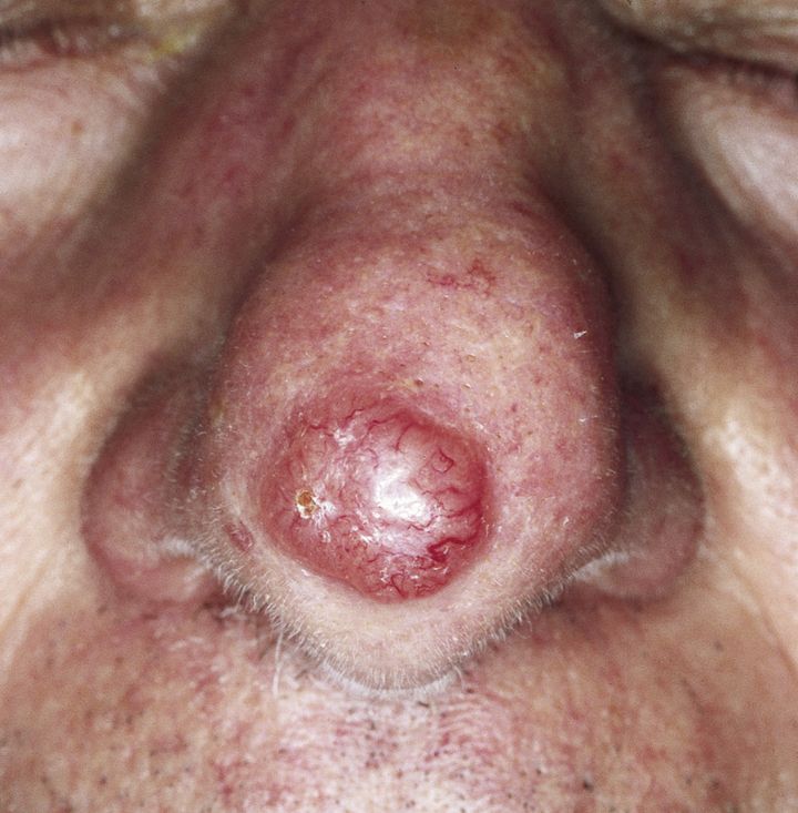 <p>Basal cell carcinoma with telangiectasias</p>