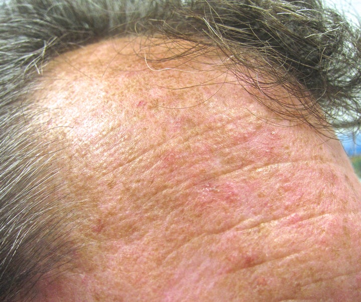<p>Actinic keratosis, can become squamous cell carcinoma</p>