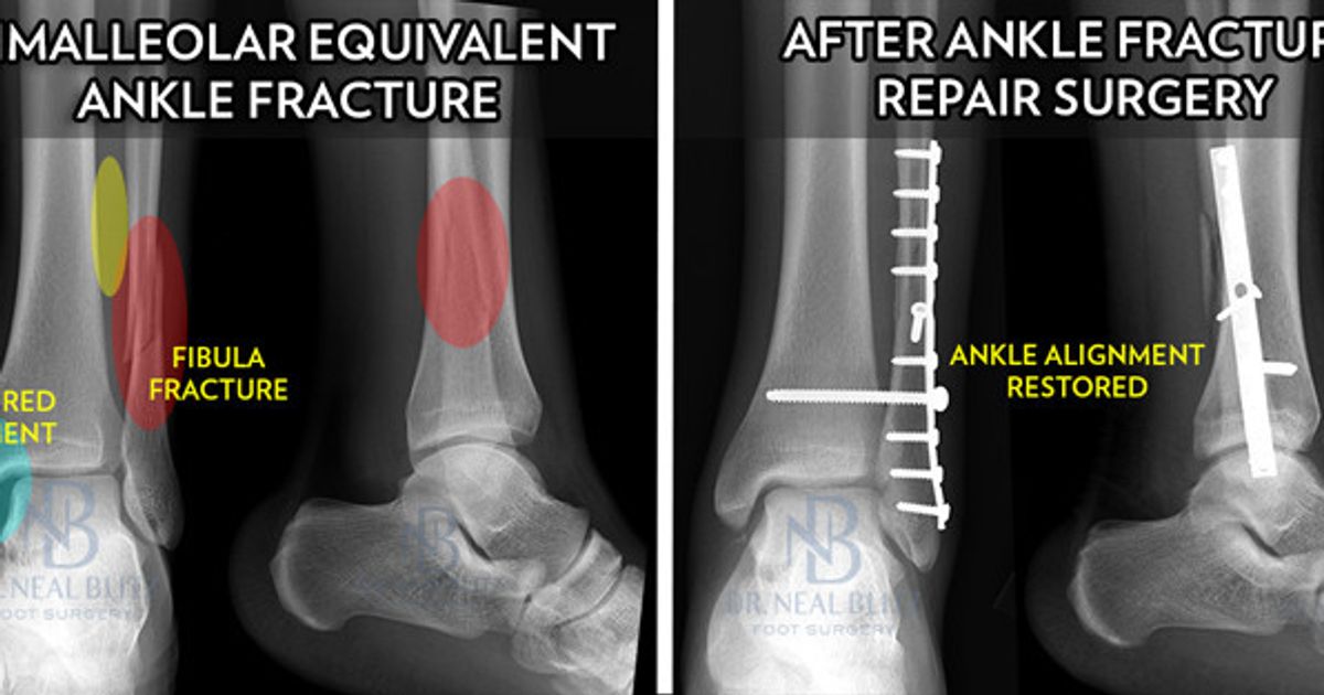 What You Need To Know About Odell Beckham’s Pending Ankle Fracture ...