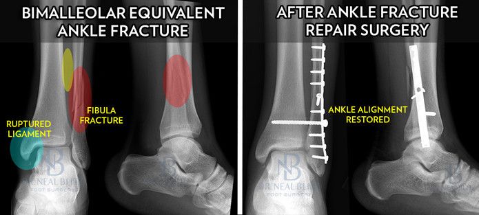 An example of a high energy ankle fracture requiring surgery.