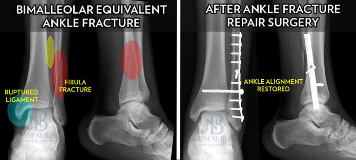 What You Need To Know About Odell Beckham’s Pending Ankle Fracture ...