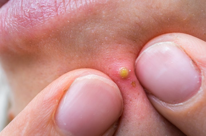 The Viral Pimple Popping Stories That Chronicle Our Grossest