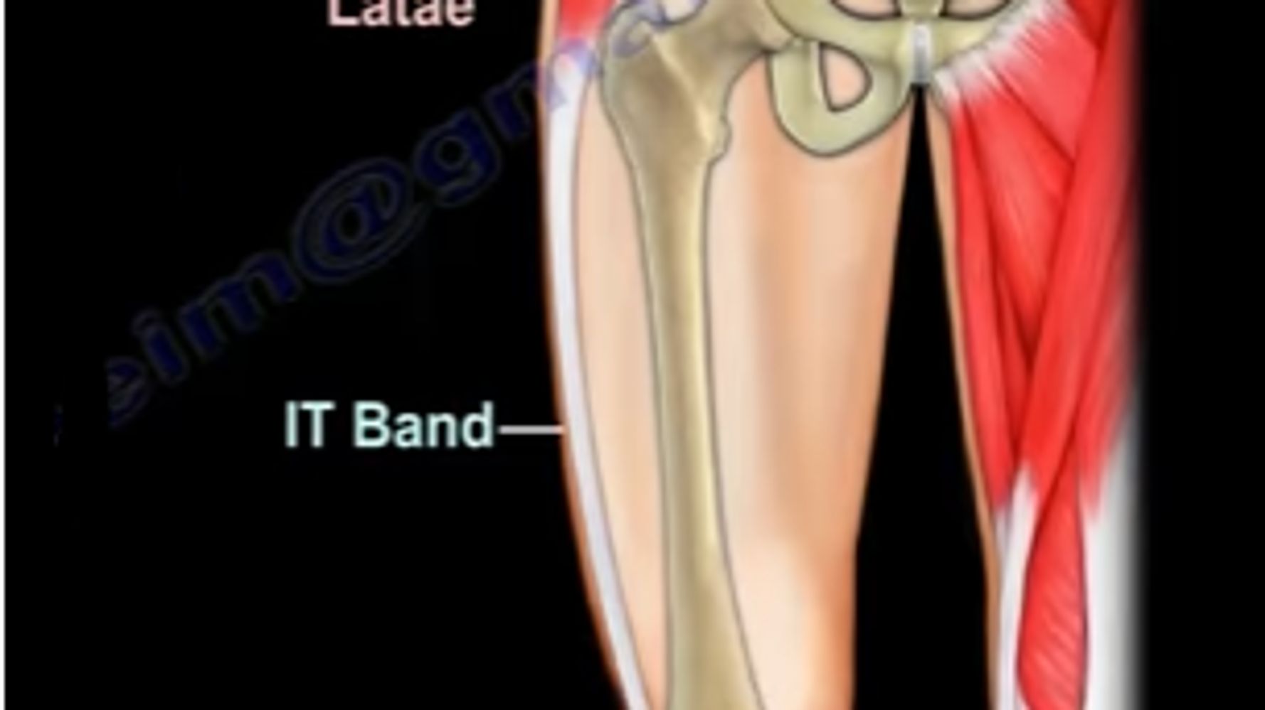 Iliotibial Band Syndrome- Around the Knee
