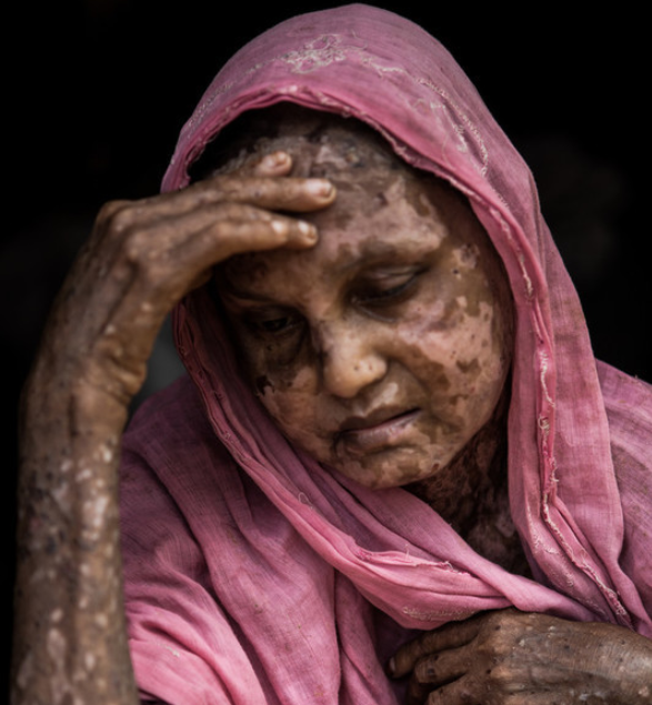 Shara Jahan, sitting for a portrait in Bangladesh's Kutupalong Refugee Camp, was badly burned before she fled