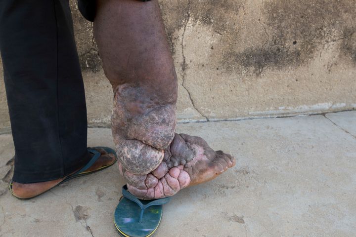 A man in Nigeria with severe elephantiasis.