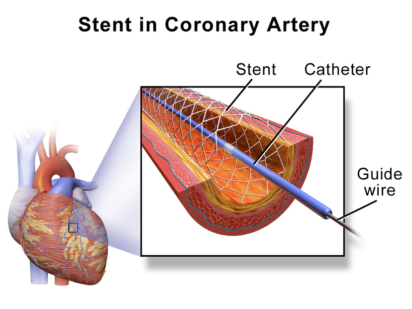 Stenting in a coronary artery - the ABS Stenting System we believe will be shown to simplify the process, eliminate gaps and overlap and simplify inserting stents into challenging spots like bifurcations.