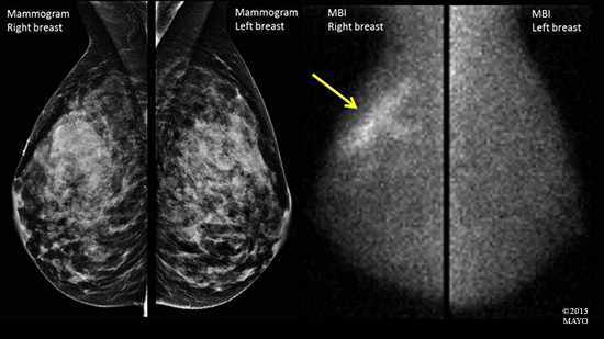 <p>The difference between a mammogram (left) and MBI (right).</p>
