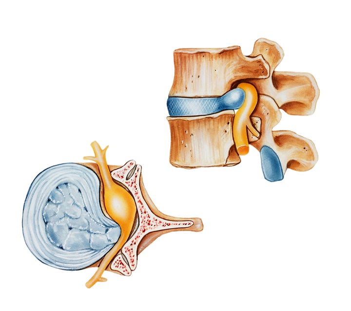 <p>Herniated Disc</p>
