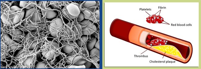 Left: Red blood cells trapped in a fibrin network (magnified 5000 times). Right: Cholesterol buildup narrows blood vessels and traps clots. 
