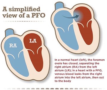 A patent foramen ovale allows mixing of blood from two upper chambers. From <a rel="nofollow" href="http://www.heart.org/HEAR